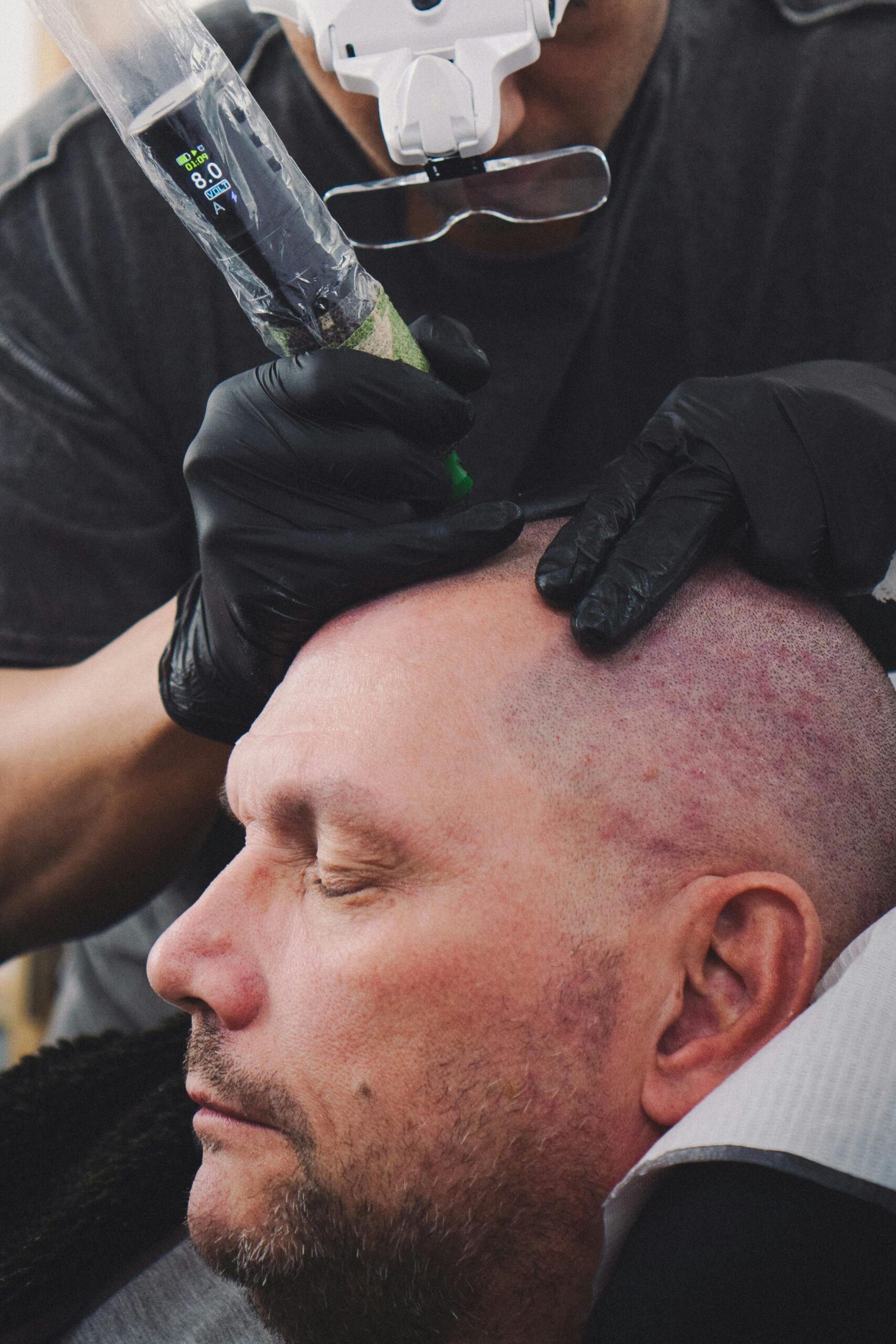 Hair Tattoo scalp restoration in cavite